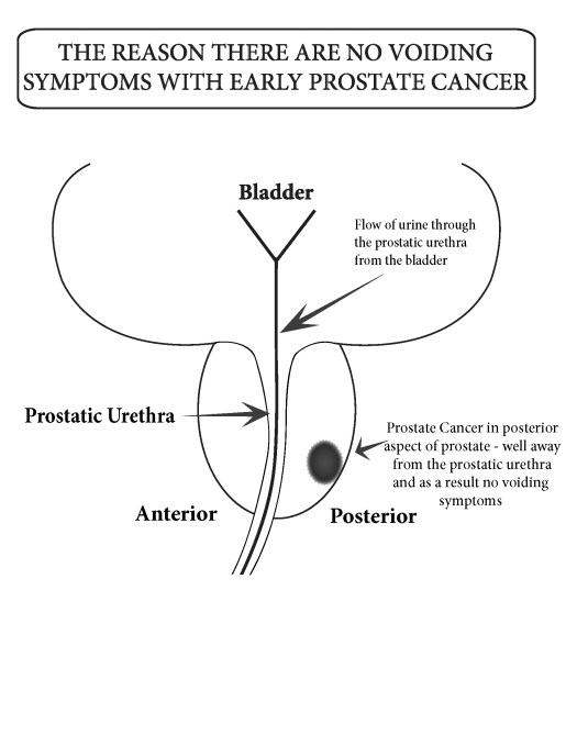 24_no_voiding_symptoms_with_prostate_cancer.tiff
